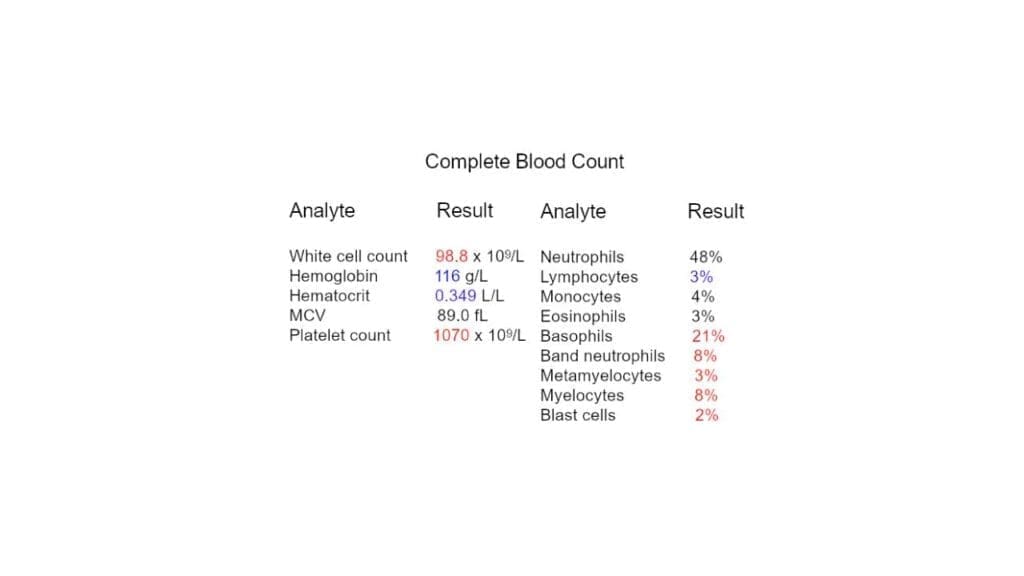 Complete blood count results showing leukocytosis, anemia and thrombocytosis.