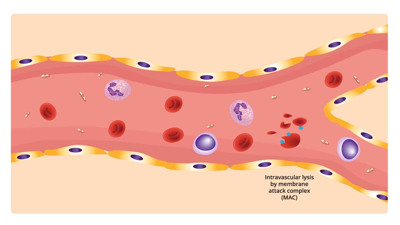 Diagram of intravascular hemolysis mechanism due to AIHA. A red blood cell is being lysed (broken apart) by round-shaped structures called the membrane attack complex (MAC) within a blood vessel. MAC is formed by immune system proteins and disrupts the red blood cell membrane, causing it to burst. This process can occur when antibodies or other proteins attach to the red blood cell surface, contributing to hemolytic anemia and eventually hemoglobinuria