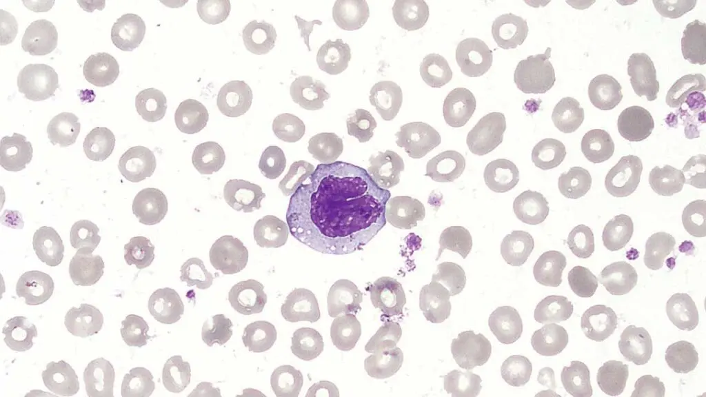 Monocyte in a peripheral blood smear with the characteristic U- or kidney-shaped nucleus. Monocyte is part of the WBCs.