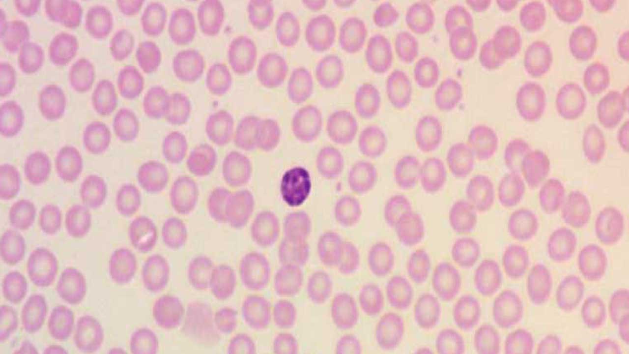 Normal RBC morphology with approximately 1/3 central pallor, a characteristic reflecting the unique biconcave shape of the RBCs using the Leishman stain. The average diameter is approximately 7.2 μm (6.7–7.7 μm). A small lymphocyte in the middle can be used as a subjective measurement of the RBC size.