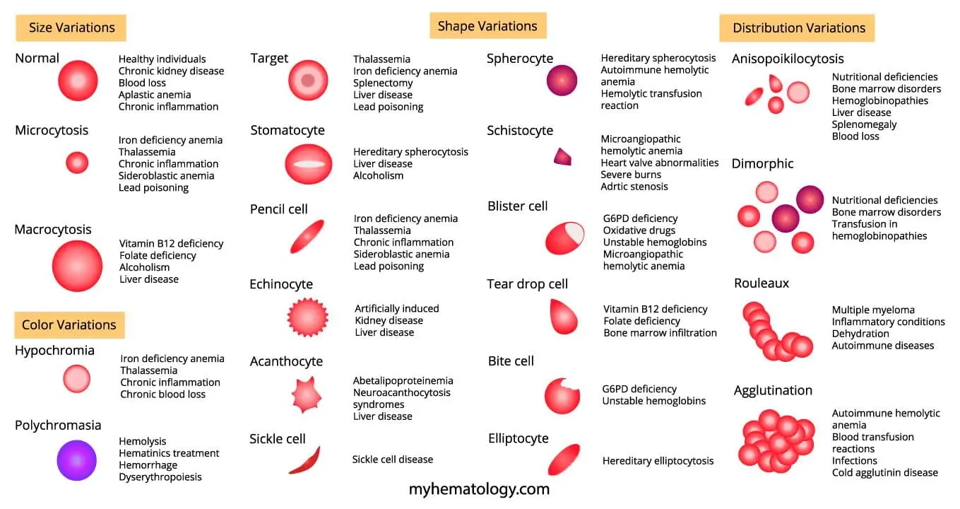 An infographic of common abnormal red blood cell morphology terms and causes.