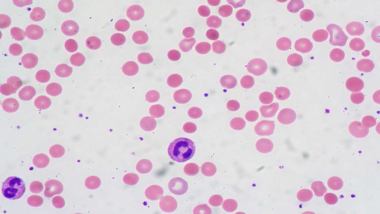 Warm Autoimmune Hemolytic Anemia (warm AIHA)