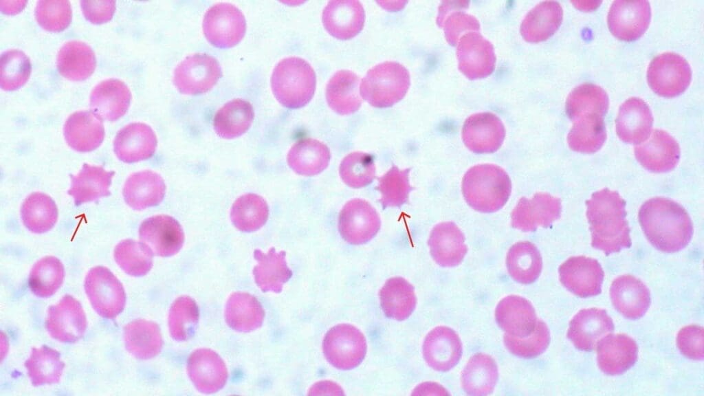 Diagram of a peripheral blood smear showing several acanthocytes marked with a red arrow. These acanthocytes have numerous, irregularly spaced spikes projecting from their surfaces, giving them a spiky or spur-like red blood cell morphology appearance