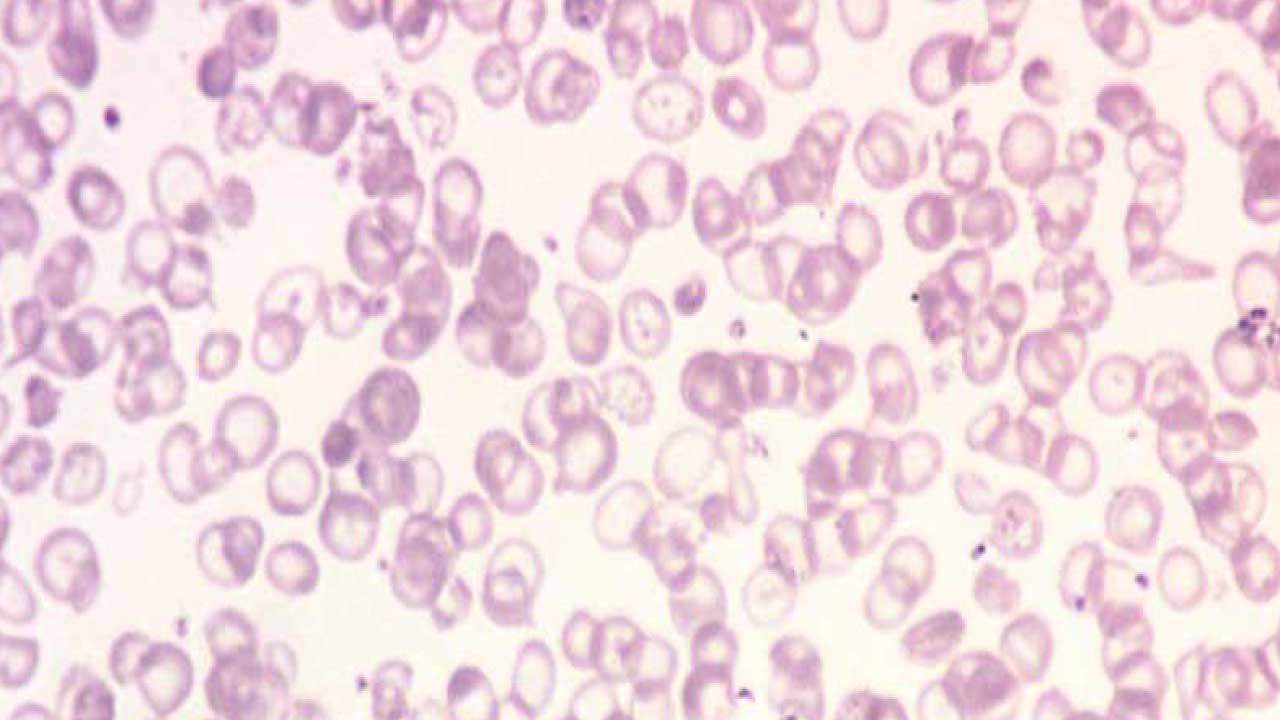 Thalassemia