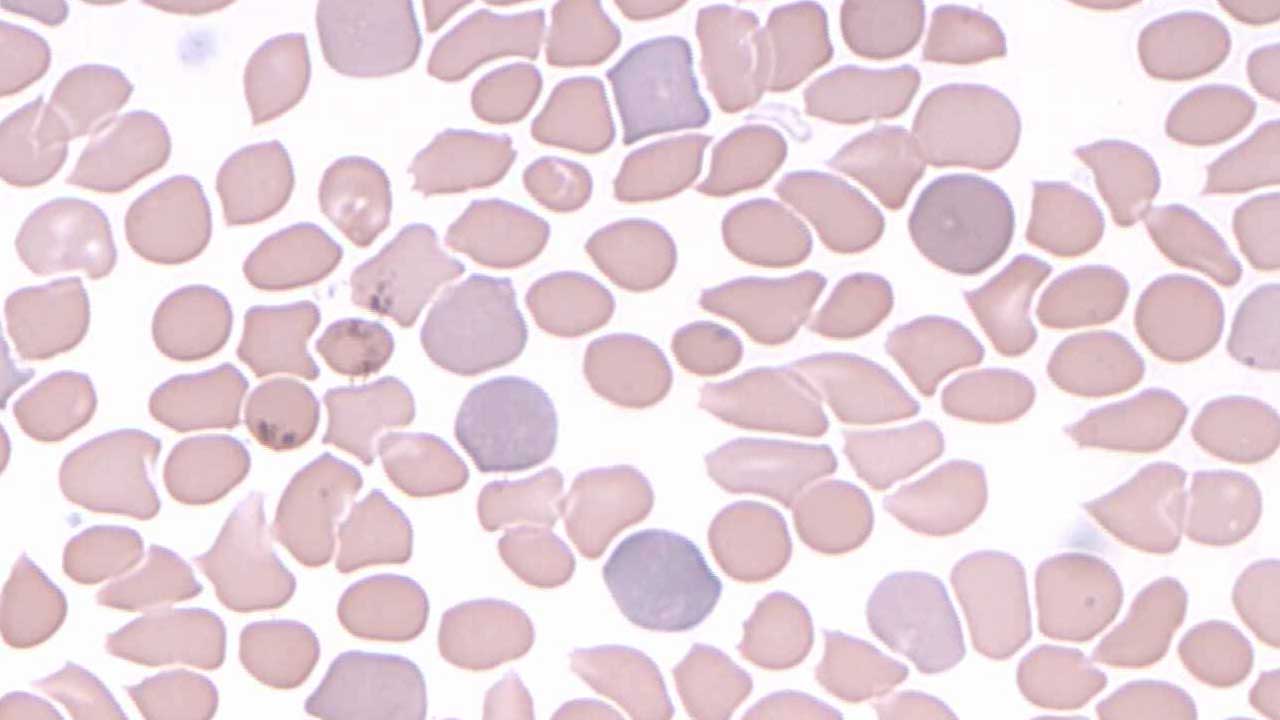 Polychromatic red cells or polychromasia are immature red cells known as reticulocytes. They are larger and stain with a bluish hue compared to mature red cells.