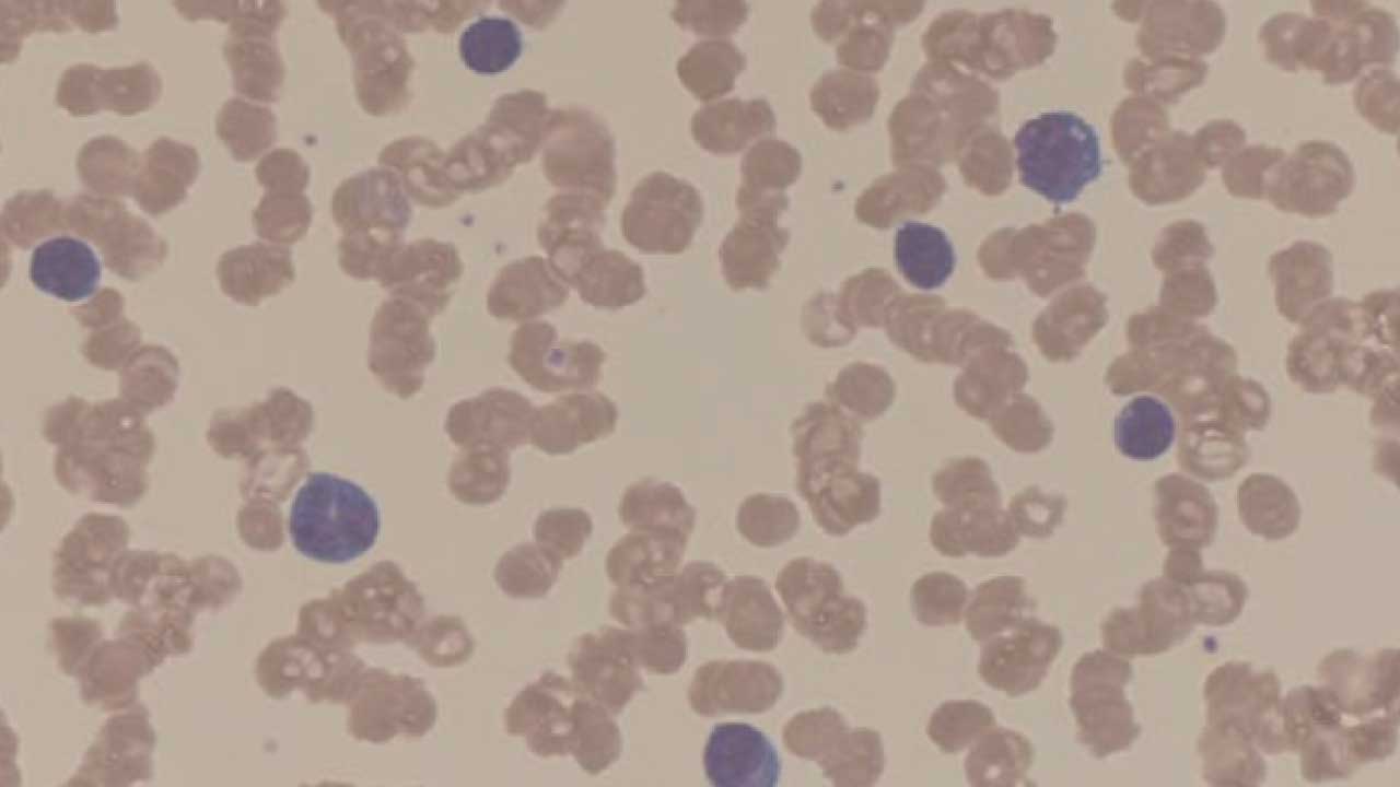 Rouleaux formation, pronounced "roo-loh," is a phenomenon observed on a peripheral blood smear where red blood cells (RBCs) appear stacked face-to-face, resembling stacks of coins in the red blood cell morphology.