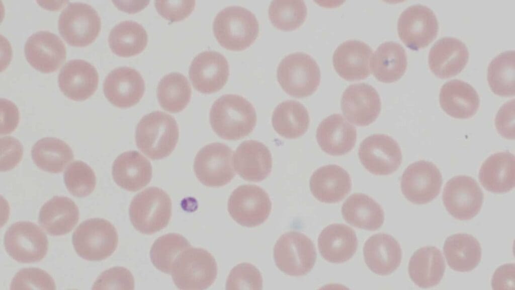 Stomatocytes red blood cell morphology in the peripheral blood smear can be seen in hereditary stomatocytosis.