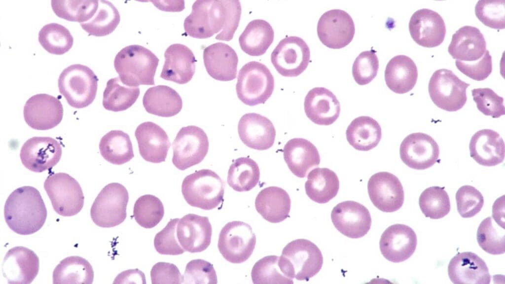 Target cell (codocyte) is a type of red blood cell morphology found in disorders like liver disease, hemoglobinopathies and iron deficiency anemia amongst others.