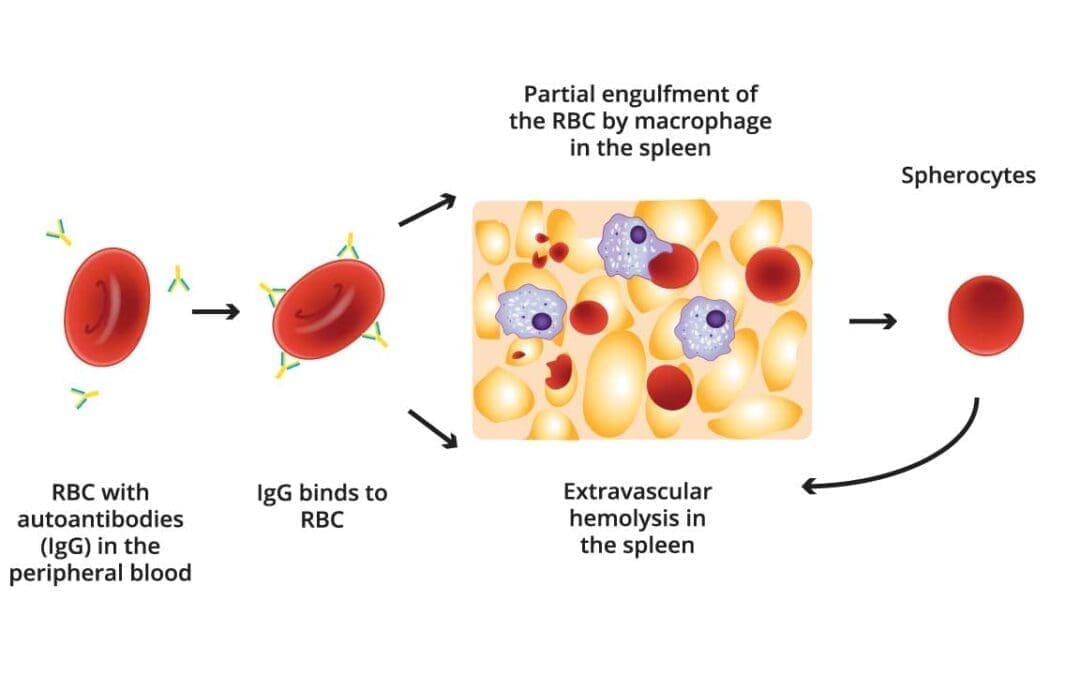 Autoimmune Hemolytic Anemia (AIHA)