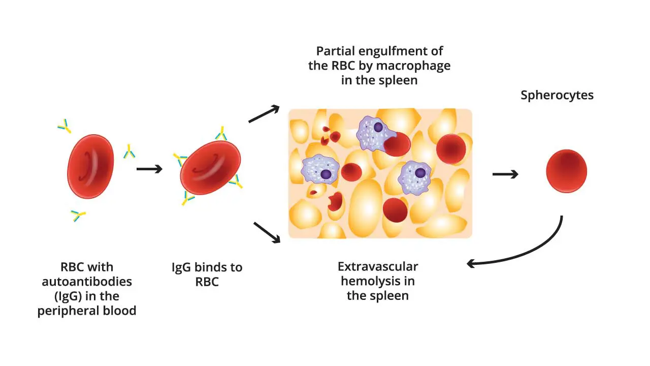 A diagram depicting the process of warm autoimmune hemolytic anemia (AIHA). Red blood cells are bound by IgG molecules. The diagram shows the red blood cells being engulfed by macrophages in the spleen. Additionally, some misshapen red blood cells, labeled as spherocytes, are shown leaving the spleen.