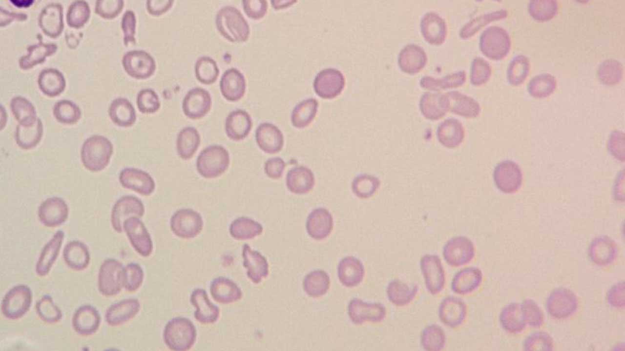 Microscopic examination of a blood smear reveals severe iron deficiency anemia, the most common cause of hypochromic microcytic anemia. The red blood cells are small (microcytosis) and pale (hypochromia), with some showing a target shape (target cells). Additionally, there's a significant variation in both size and shape of the red blood cells (marked anisopoikilocytosis).