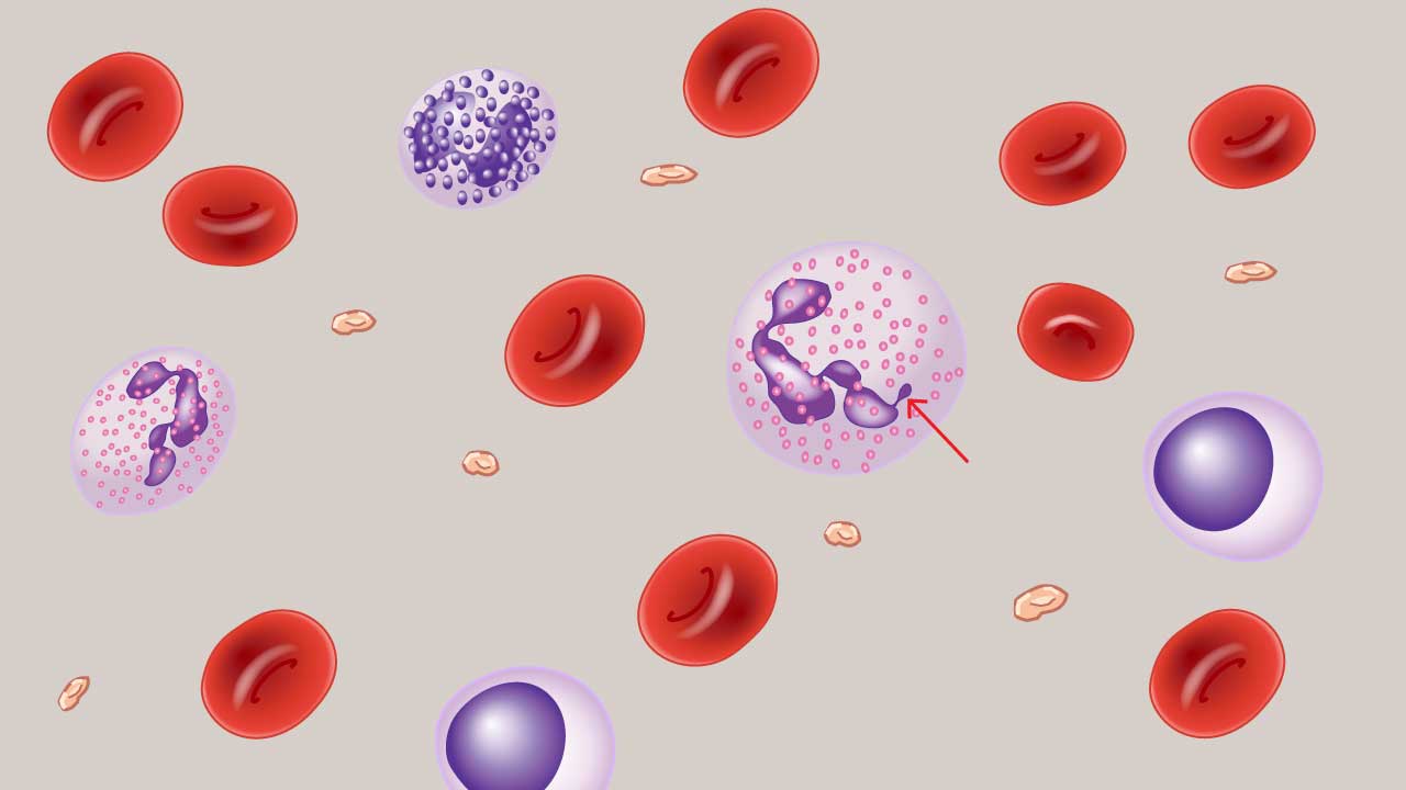 Presence of drumstick neutrophil in a schematic diagram.
