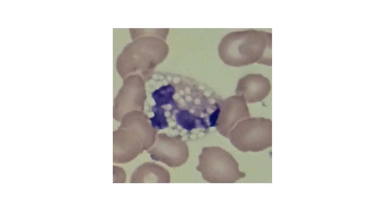 Presence of toxic vacuolation in a neutrophil in the peripheral blood smear.
