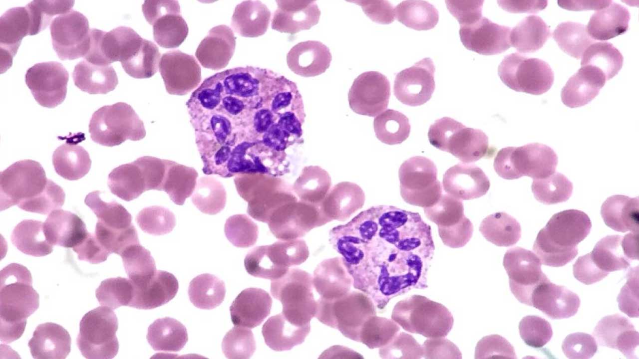 Two hypersegmented neutrophils seen in a peripheral blood smear indicating abnormal WBCs.