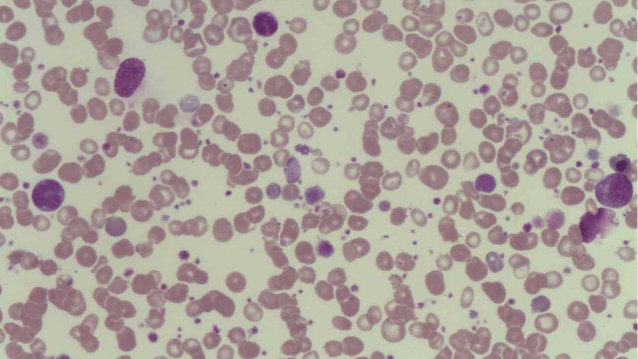 Platelet function disorder: Bernard-Soulier syndrome with giant platelets in the peripheral blood smear
