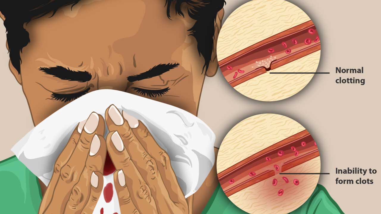 Coagulation (Clotting) Disorders