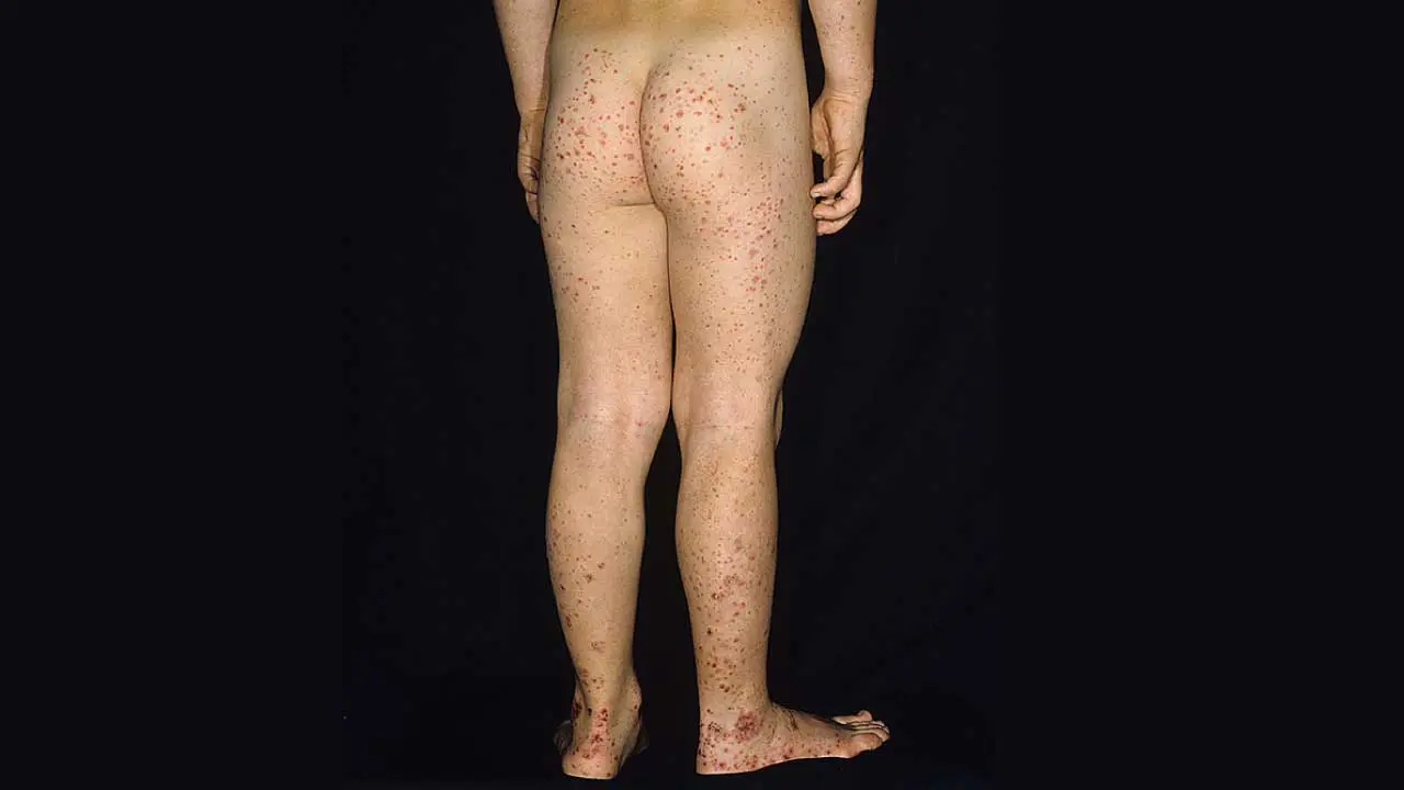 Vascular Bleeding Disorders