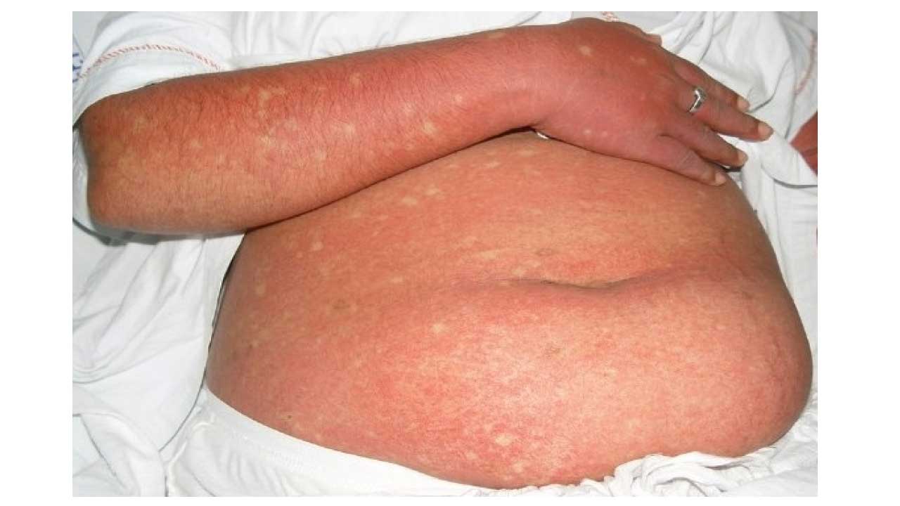 Dengue & Thrombocytopenia