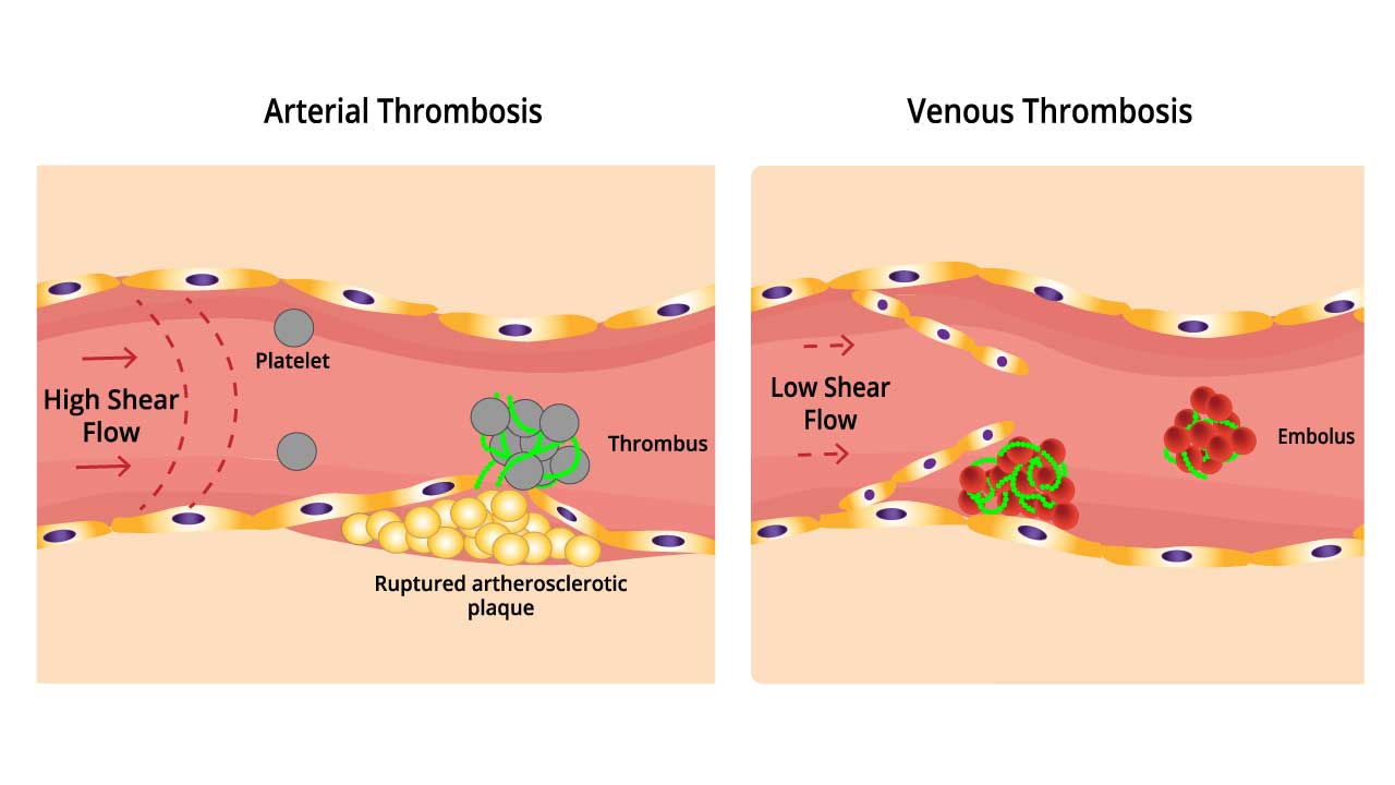 Thrombosis: An Overview