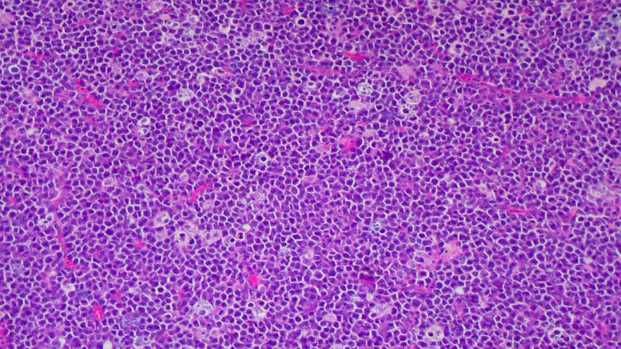 Burkitt Lymphoma