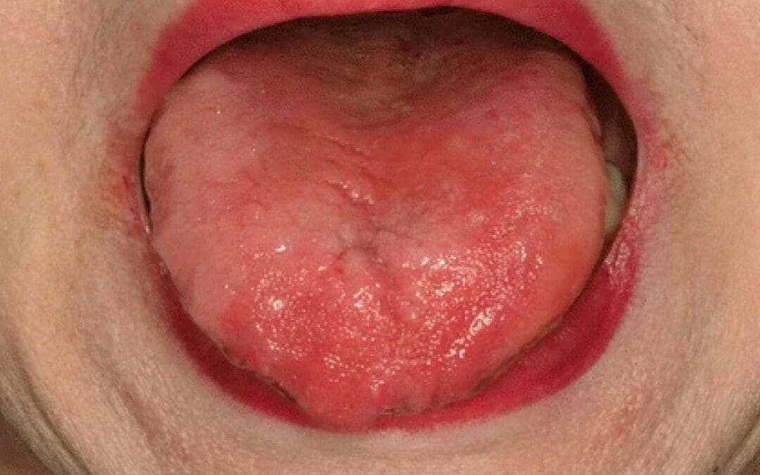 Pernicious Anemia