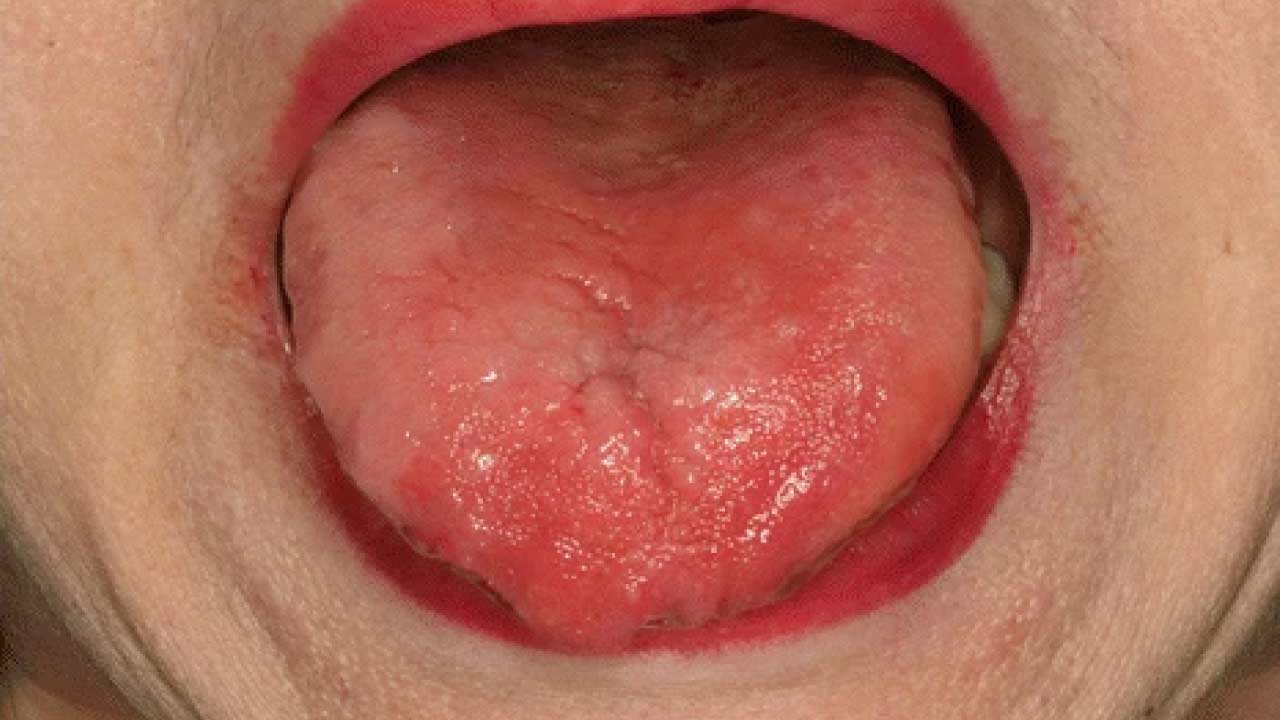 Pernicious Anemia
