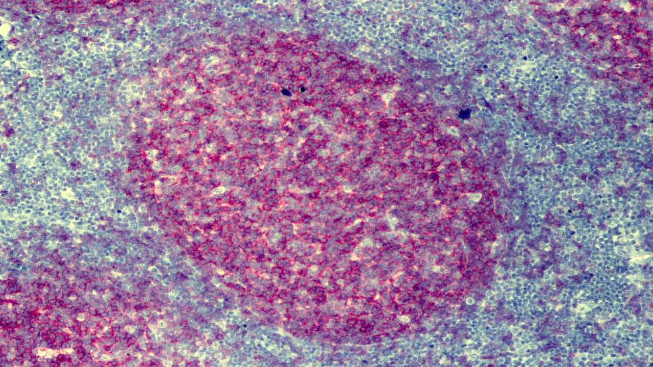 Follicular Lymphoma