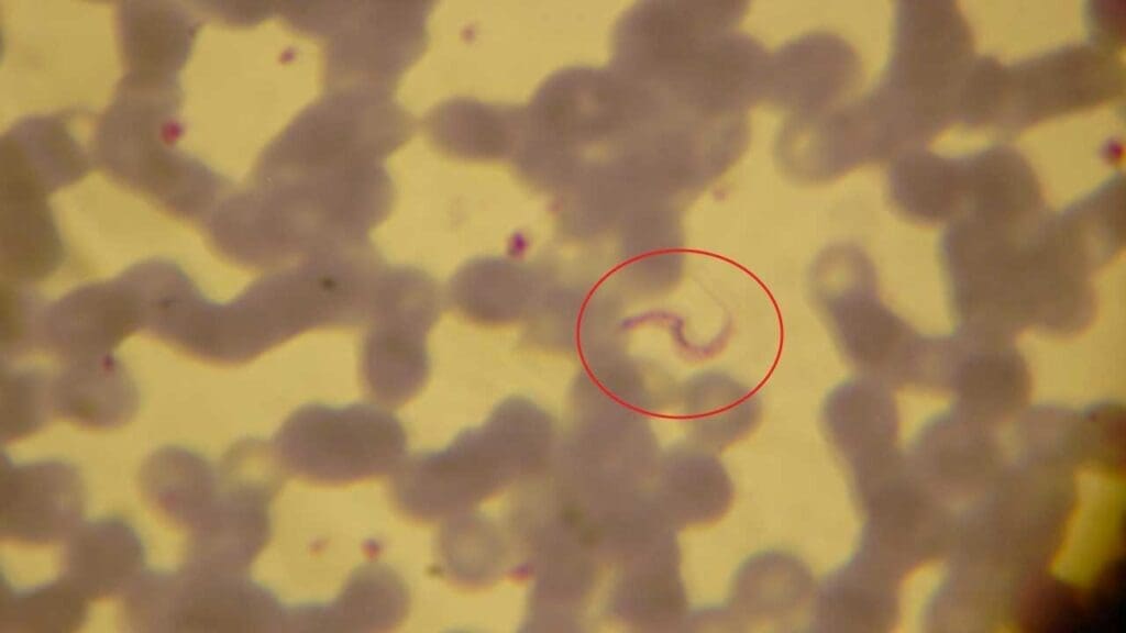 African trypanosomiasis seen in thick blood film.