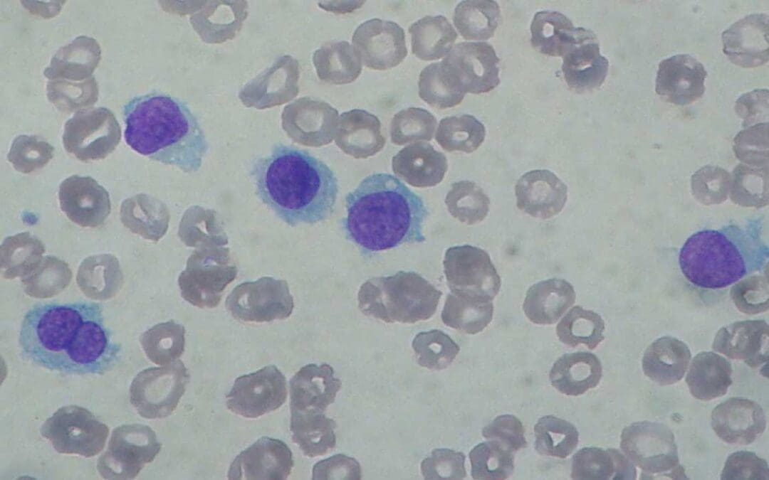 Hairy Cell Leukemia (HCL)