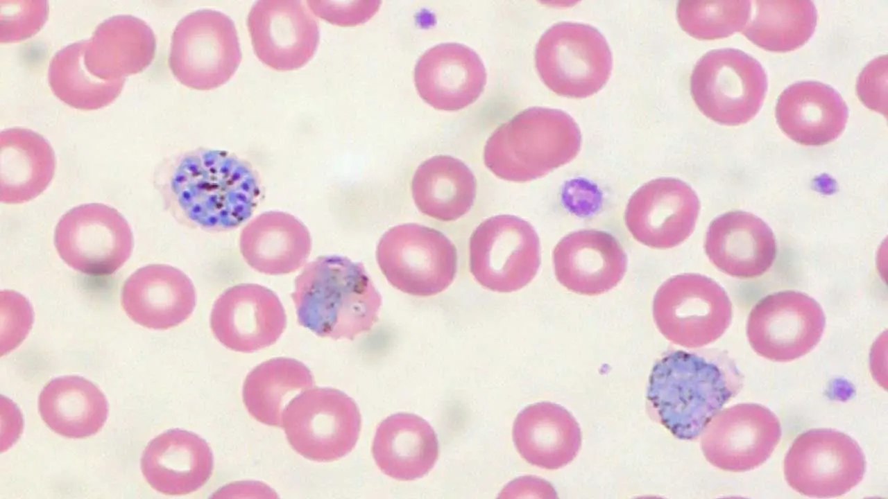 Severe Malarial Anemia