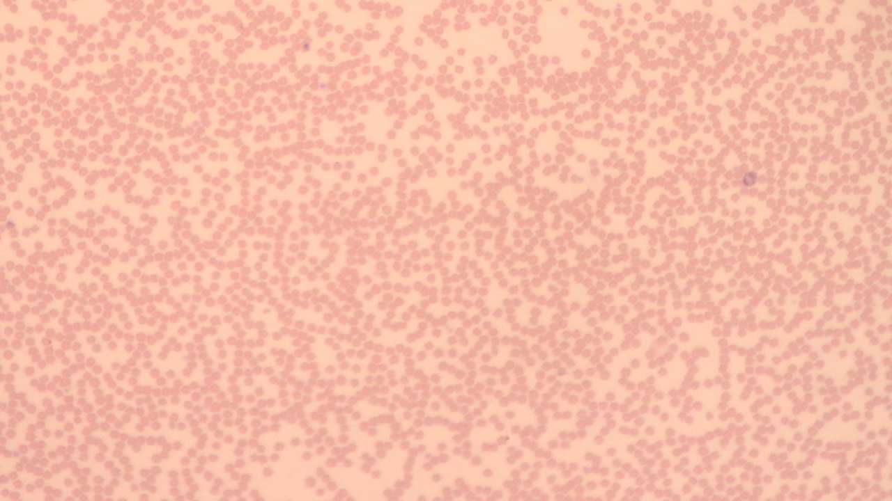 Neutropenia