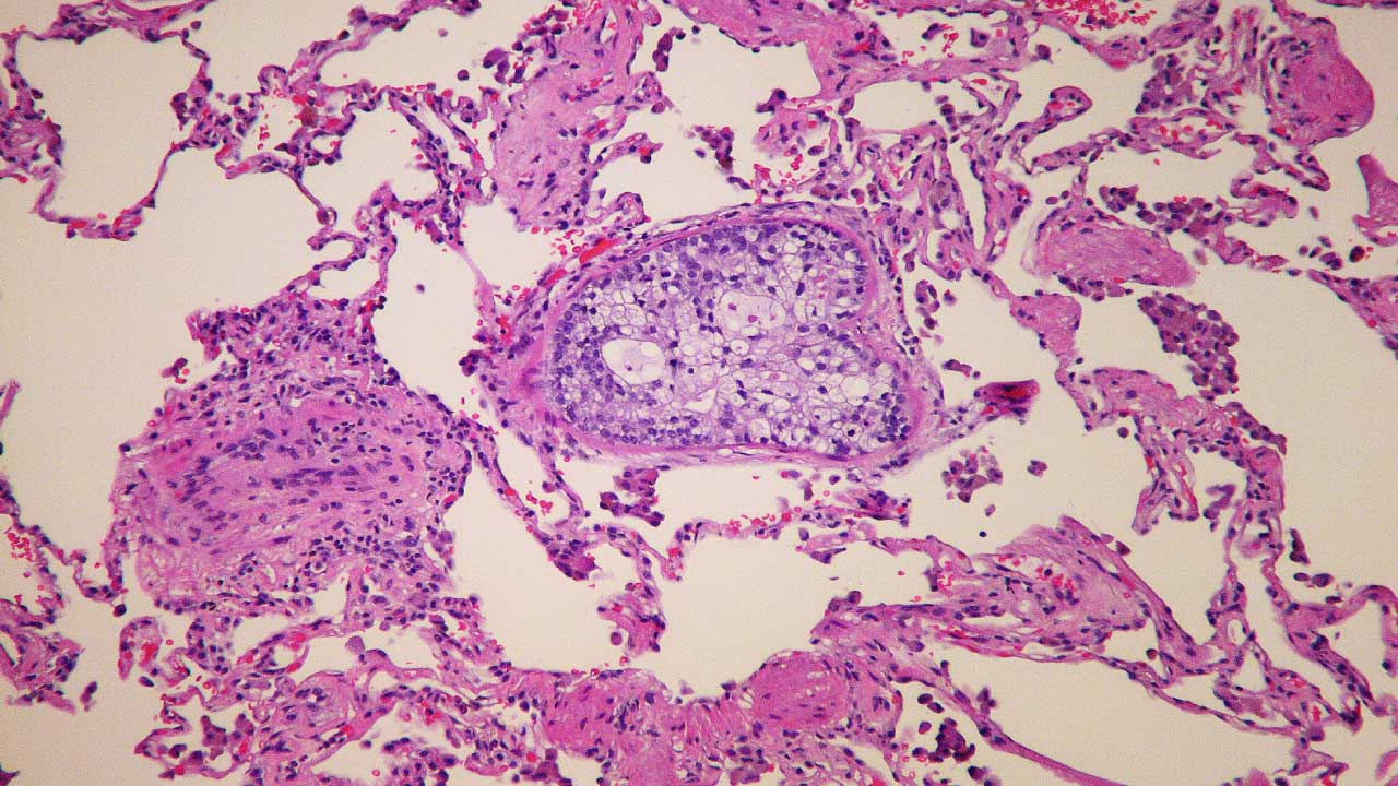 Embolus & Embolism