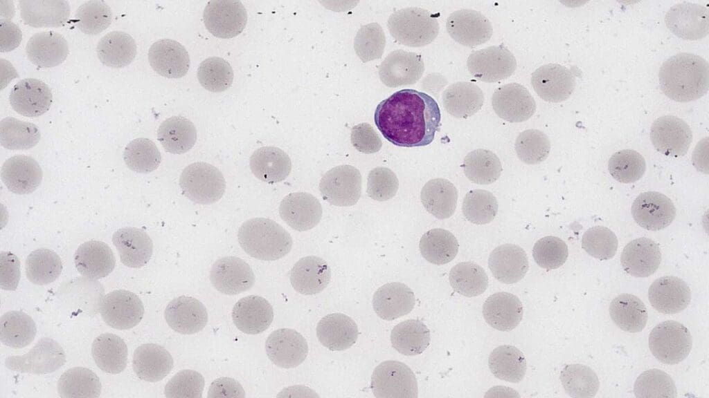 Normal lymphocytes are typically small cells with a large, dark, spherical nucleus that almost fills the cell, surrounded by a scant rim of pale blue cytoplasm.
