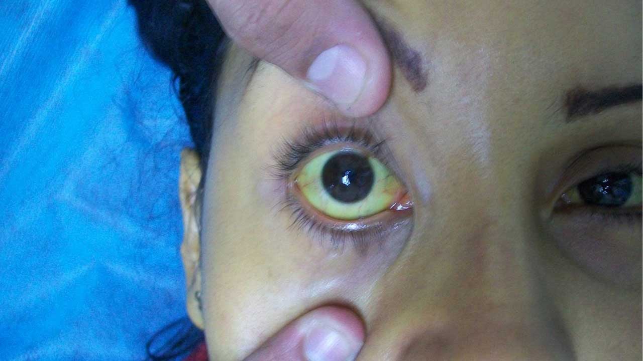 Jaundice (Hyperbilirubinemia)