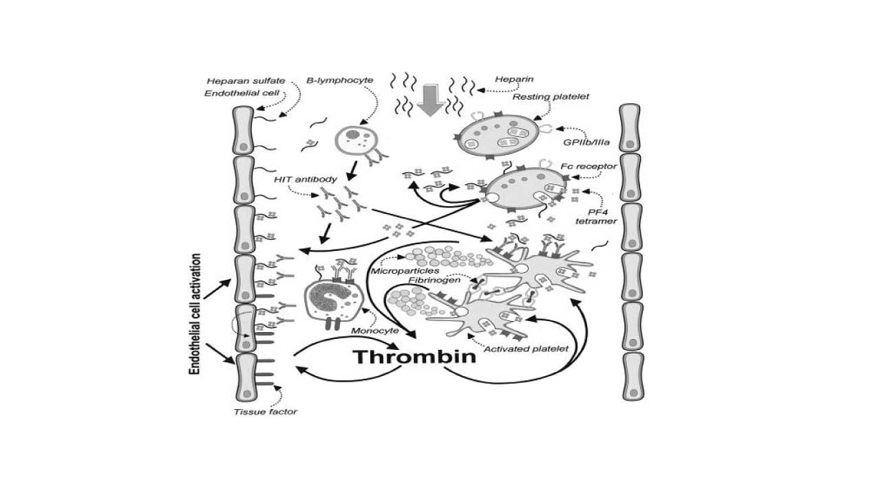 Heparin-Induced Thrombocytopenia