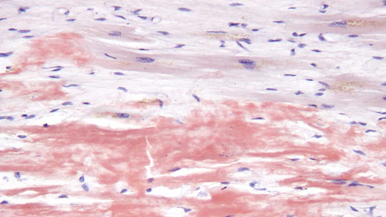 AL Amyloidosis (Primary Amyloidosis)