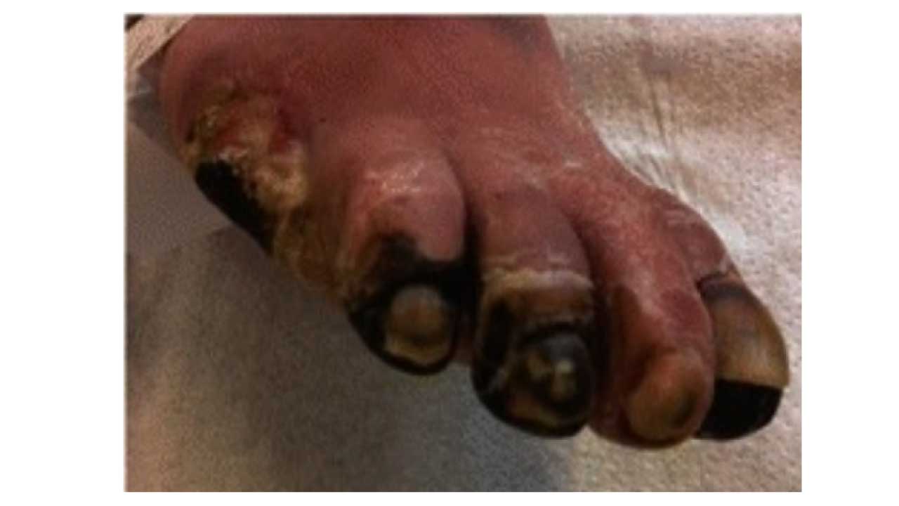Necrosis of multiple toes as a complication of peripheral arterial disease