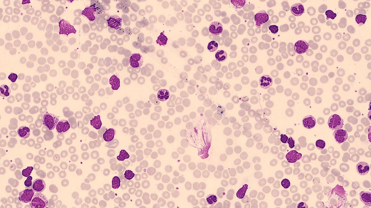 Absolute neutrophilia or high neutrophils can be seen in chronic myeloid leukemia