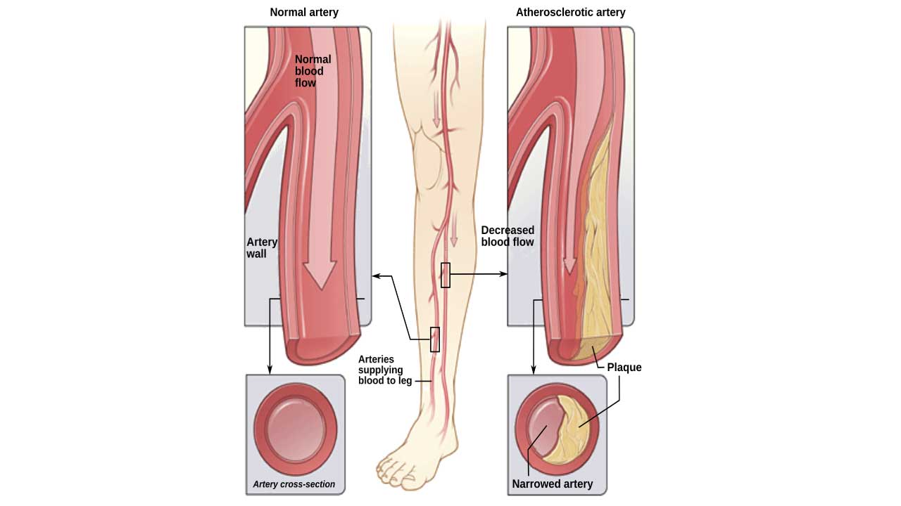 An illustration of the effect of peripheral artery disease in a leg artery. 