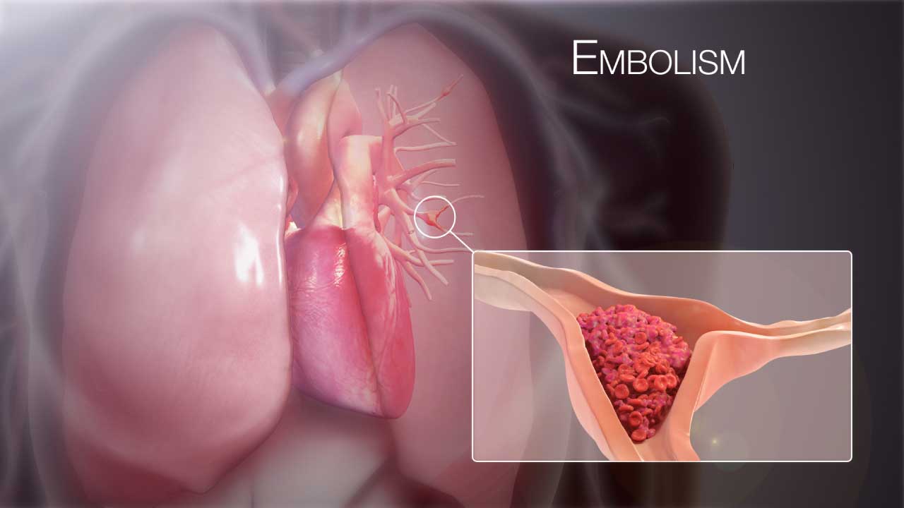 Pulmonary Embolism (PE)