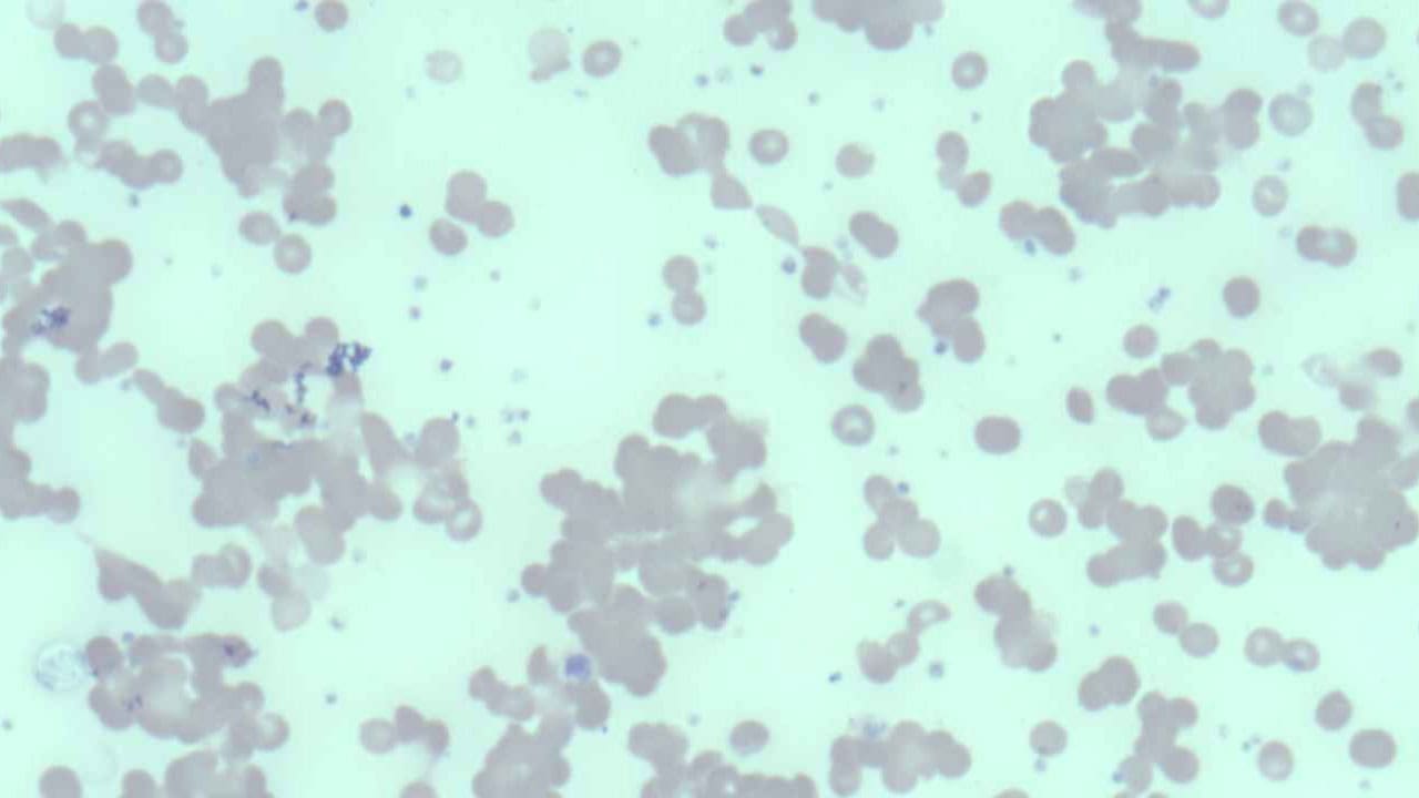 Cold Agglutinin Disease