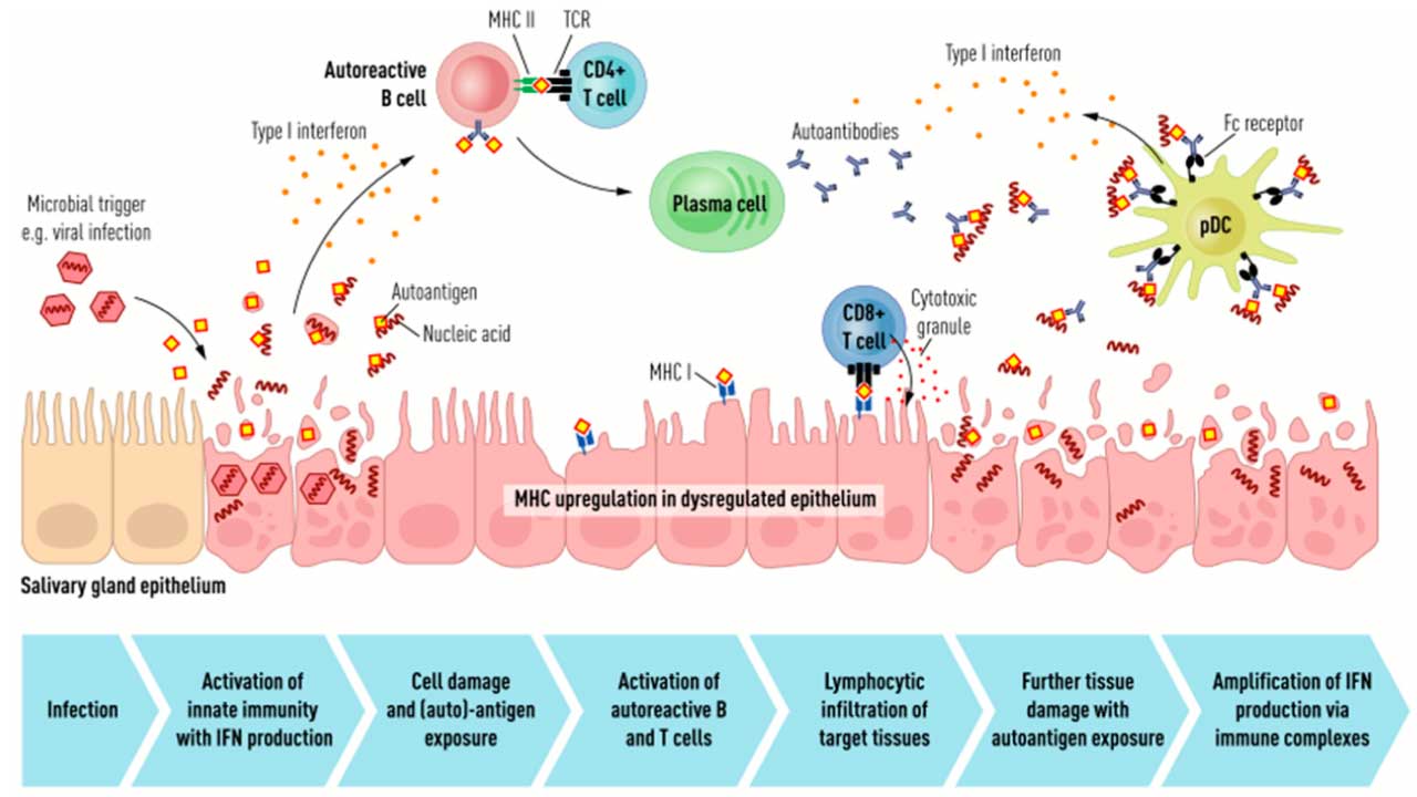 Pathophysiology of Sjögren's syndrome