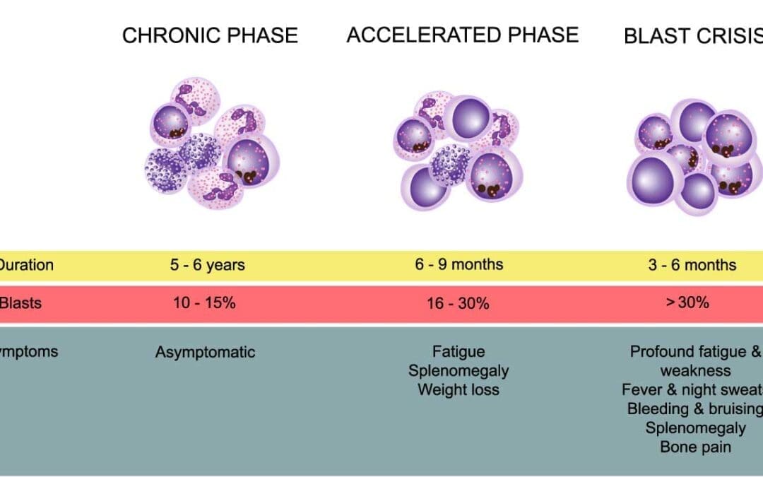 Chronic Myeloid Leukemia Treatment Strategies