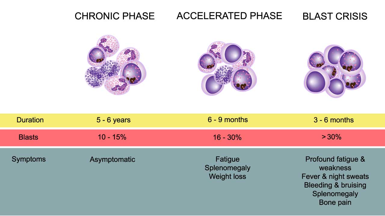 The 3 phases of chronic myeloid leukemia. Chronic Myeloid Leukemia (CML) typically progresses through three phases that reflect increasing disease aggression and guide management. The initial and longest stage is the Chronic Phase (CP), where most patients are diagnosed; it is characterized by stable blood counts, mild or absent symptoms, and blast counts remaining below 10% in the blood and bone marrow, and it is highly responsive to Tyrosine Kinase Inhibitor (TKI) therapy. If left untreated or in the event of TKI resistance, the disease enters the Accelerated Phase (AP), a transitional stage marked by increasing difficulty in achieving remission, often defined by blast counts between 10% and 19%, or the emergence of specific hematological abnormalities (like persistent thrombocytosis or increasing basophils) or new clonal cytogenetic evolution. The final and most severe stage is Blast Crisis (BC), which is an aggressive transformation into acute leukemia, defined by blast counts of 20% or more in the peripheral blood or bone marrow, often leading to rapid organ infiltration and requiring intensive chemotherapy or allogeneic stem cell transplant.