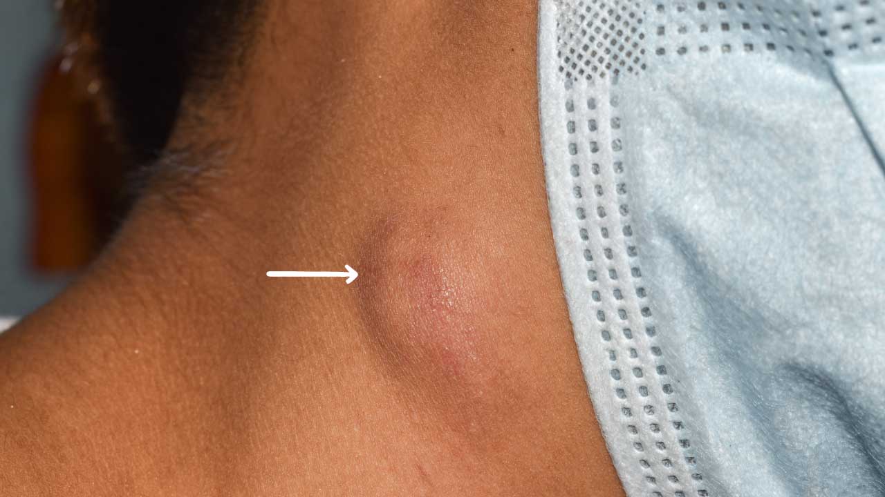 Lymphadenopathy