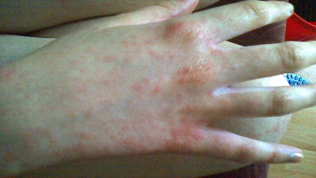Hand rash (amoxycillin-related) in infectious mononucleosis.