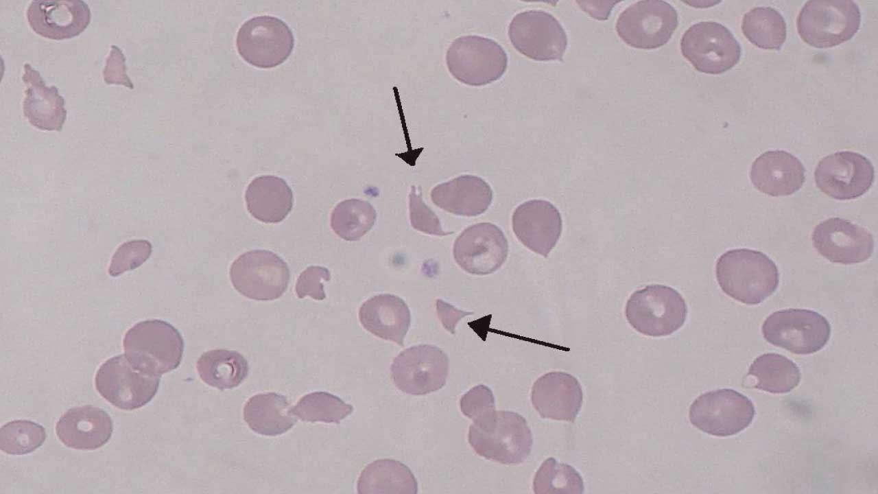 Hemolytic Uremic Syndrome (HUS)