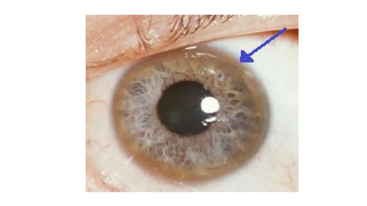 Wilson’s Disease