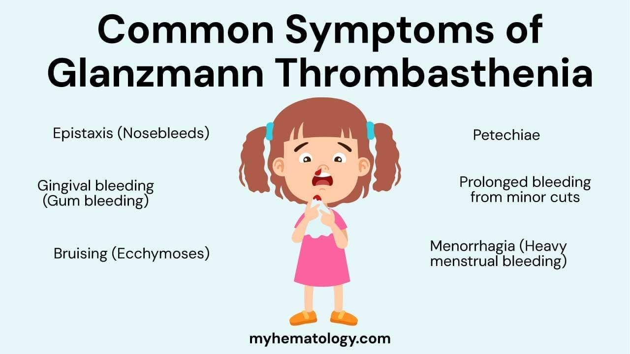 Common symptoms of Glanzmann thrombasthenia include epistaxis, gingival bleeding, bruising, petechiae, prolonged bleeding and menorrhagia.