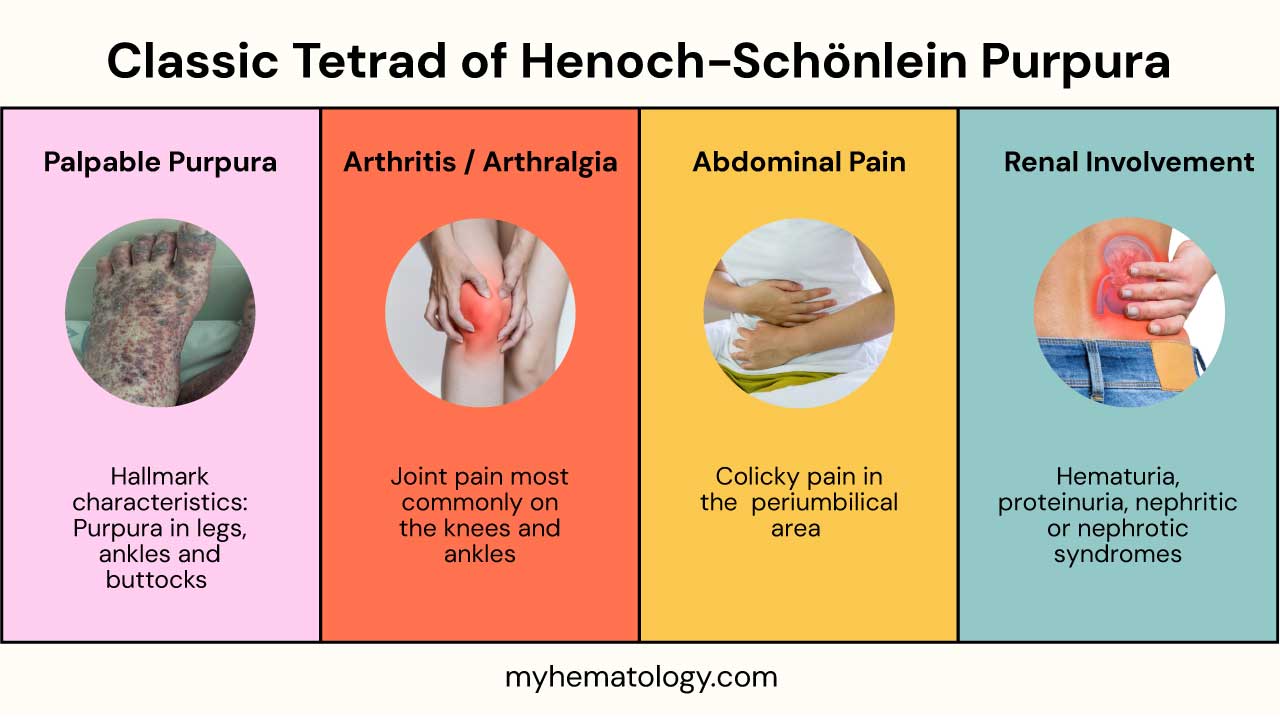 Classic tetrad of Henoch-Schönlein Purpura (HSP)